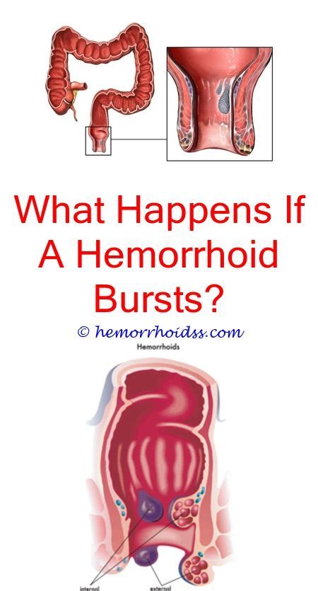 What Does A Surface Hemorrhoid Look Like How To Repair Hemorrhoids