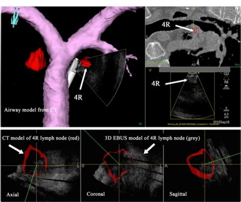 3d Endobronchial Ultrasound Ebus Clinical Demonstration European