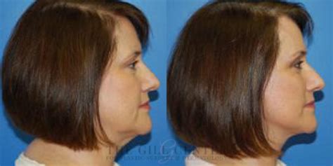 Face And Neck Lift Before And After Photos Patient 404 The Woodlands Tx