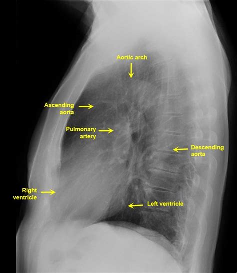Lateral Chest Radiograph Anatomy Normal Lateral Chest X Ray Male