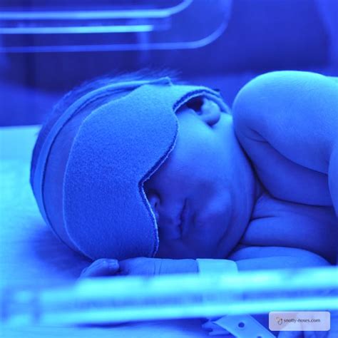 Neonatal Jaundice In Babies Snotty Noses