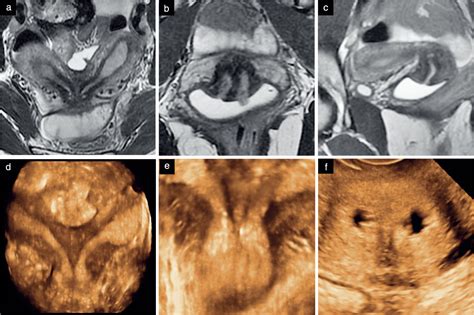 three‐dimensional ultrasound and magnetic resonance imaging assessment of cervix and vagina in