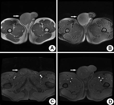 Mri Images Of Primary Testicular Nkt Cell Lymphoma A And B Show A