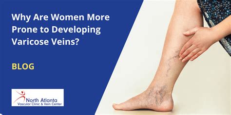 Why Are Women More Prone To Developing Varicose Veins