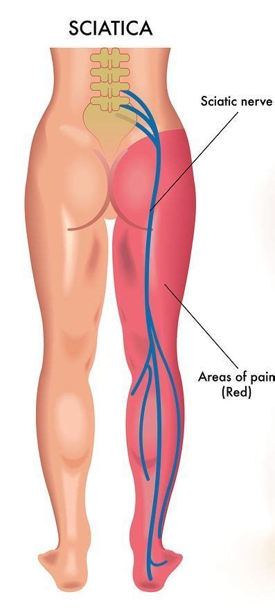 Pin On Sciatic Nerve