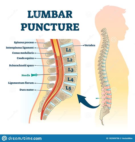 Lumbar Puncture Vector Illustration Labeled Spine