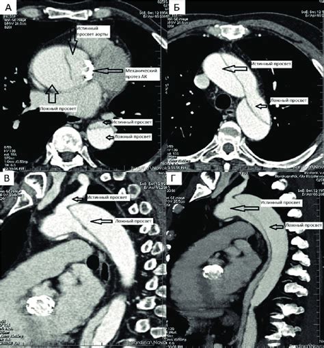 Multislice Computed Tomography Of The Aorta A Aortic Root And