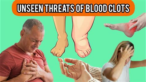 A Silent Threat 10 Warning Signs Of Blood Clots Understanding Blood