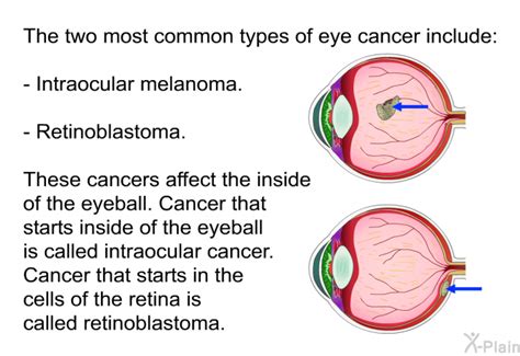 Eye Cancer