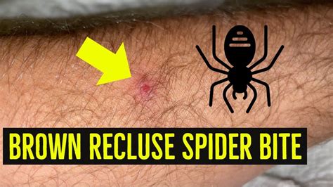 How To Treat A Brown Recluse Spider Bite Brown Reclus Vrogue Co