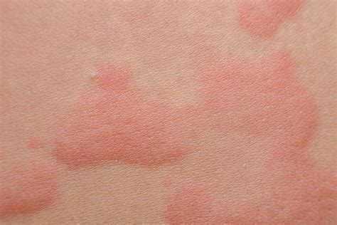 на что бывает аллергия на коже