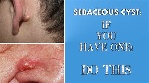sebaceous cysts do s and donts how to look after sebaceous cysts youtube