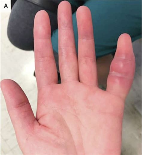 Womans Swollen Pinky Finger Was Rare Sign Of Tuberculosis Ucsf