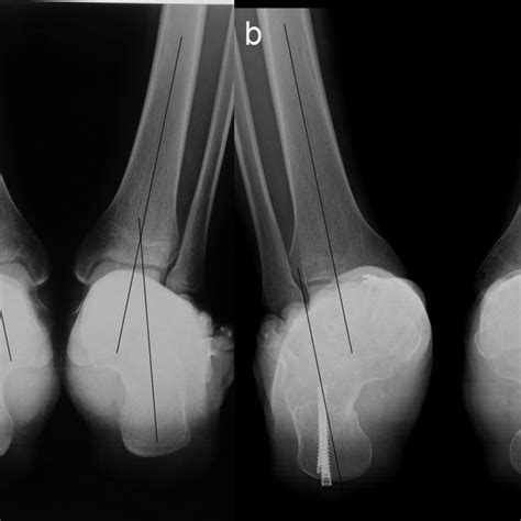 A 12 Year Old Boy With Bilateral Flexible Flatfoot Deformity Who