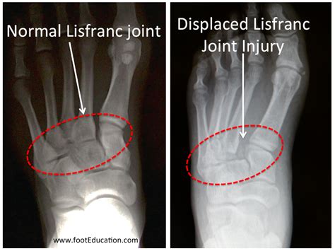Midfoot Trauma Lisfranc Injuries Orthopaedia Foot And Ankle