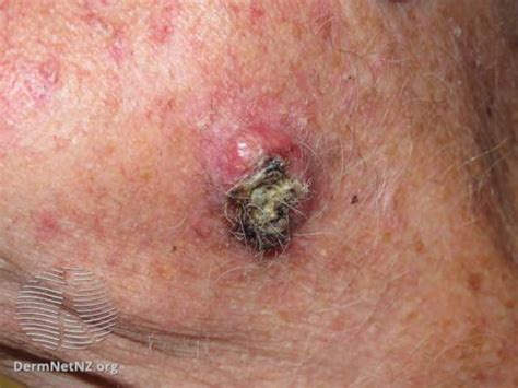 How To Tell A Lump From A Lymph Node
