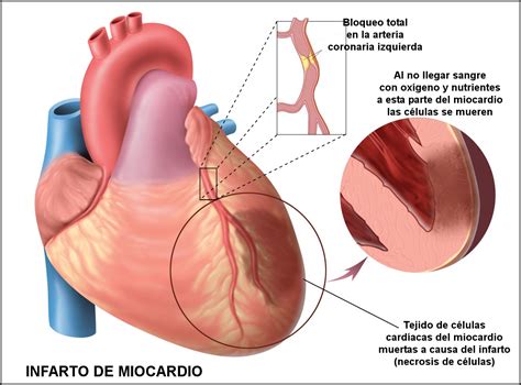 Saniblog Infarto De Miocardio Qu Es Sintomatolog A