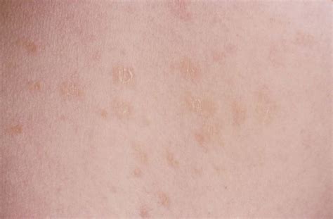 Skin Disease In Pregnancy Identifying And Treating Common And Rare