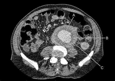 A Man With A Palpable Abdominal Mass And Night Sweats The Bmj