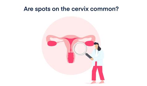 What Is White Spots On Cervix Do One Need To Worry