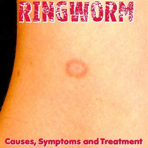 Ringworm Causes Symptoms And Treatment Healthmix Info
