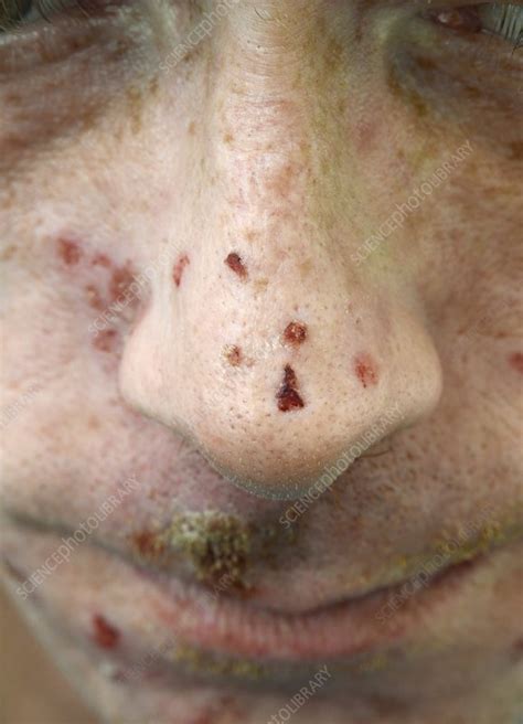 Infected Skin Lesions Stock Image C0183564 Science Photo Library