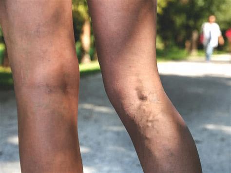 Varicose Vein Pain What It Feels Like And Relief