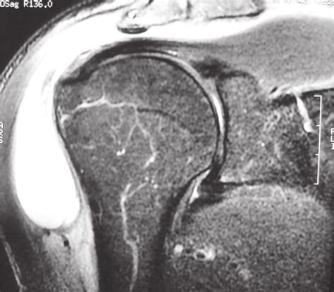 Subacromial Bursitis MRI