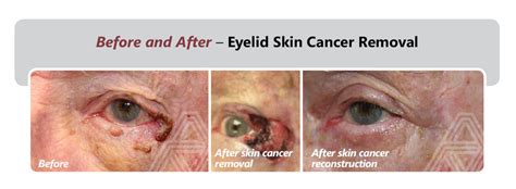 Skin Cancer On Lower Eyelid