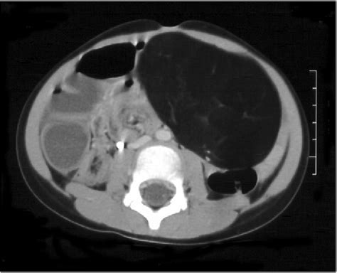 Abdominopelvic Computed Tomography Scan Shows A Huge Hypodense Mass