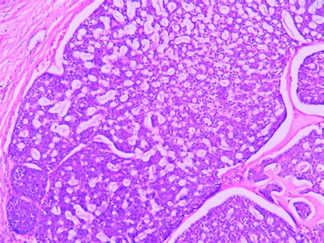 Adenoid Cystic Carcinoma Histopathologyguru