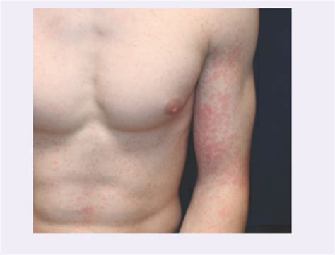 M2 Primary Skin Lesions Flashcards Quizlet