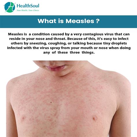 Measles Symptoms And Treatment Healthsoul