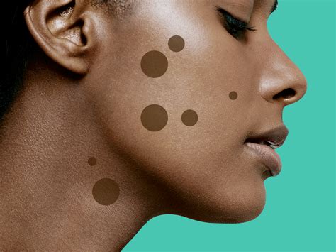 9 Dark Spot Treatments That Really Work According To Dermatologists Self
