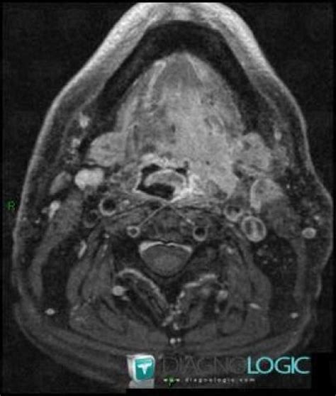 Radiology Case Carcinoma Of Base Of Tongue CT MRI Diagnologic