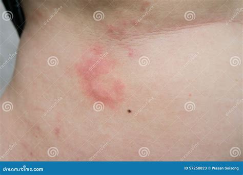 A Woman Is Urticaria On Belly Stock Image Image Of Skin Sore 57258823