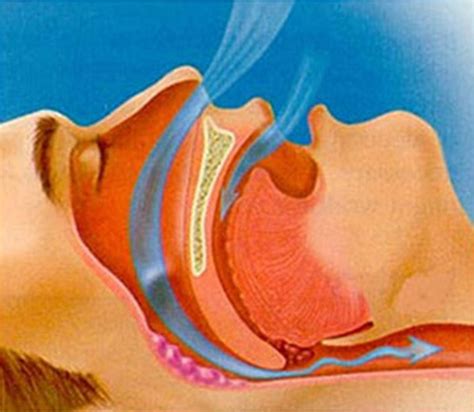 How much is a sleep apnea test. Obstructive Sleep Apnea Symptoms, Tests & Treatment In India