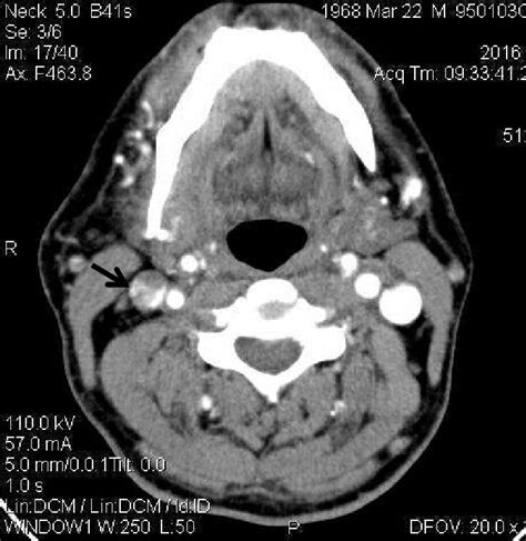 Axial Veiw Of The Neck Ct Scan With Iv Contrast Shows Thrombosis In The