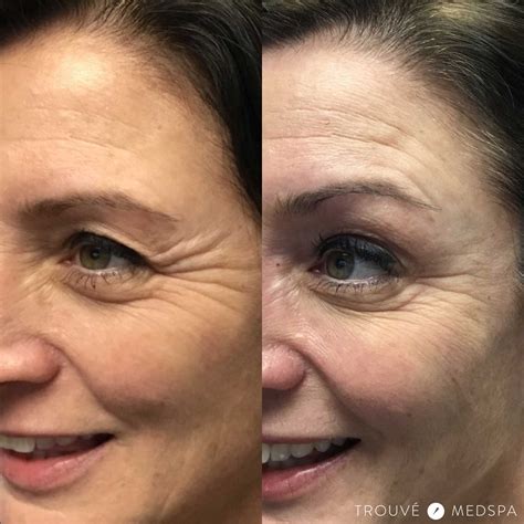 Could botox actually be aging your face? Trouvé Medspa - Crow's Feet Botox or Dysport | Cleveland