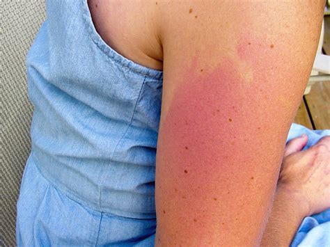How To Get Rid Of Tanning Bed Rash Fast Bed Western