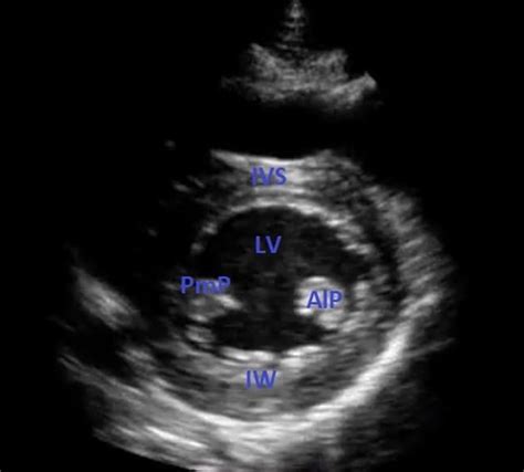 Parasternal Short Axis View Normal Transthoracic Echocardiography