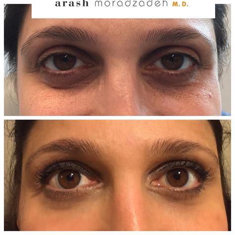 Belotero Tear Trough Filler Before And After Tuubao