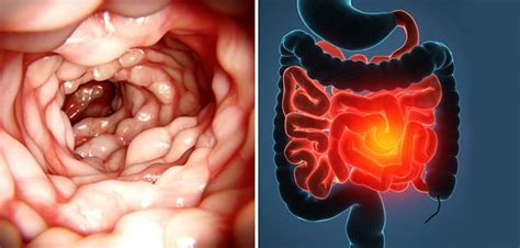 ¿qué Es La Enfermedad De Crohn Causas Síntomas Y Tratamiento