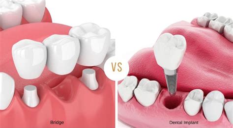 Dental Bridges Vs Implants