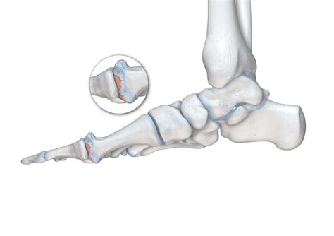 Hallux Rigidus Ursachen Symptome Und Therapie