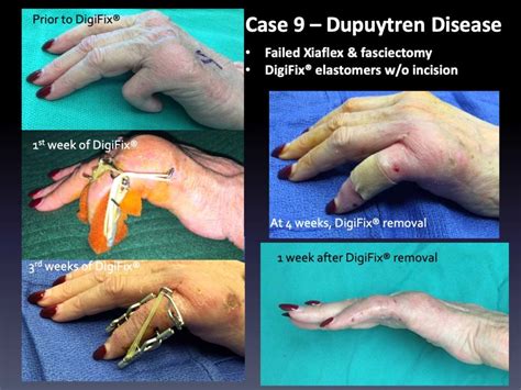 Dupuytren Disease Archives Virak Orthopedics