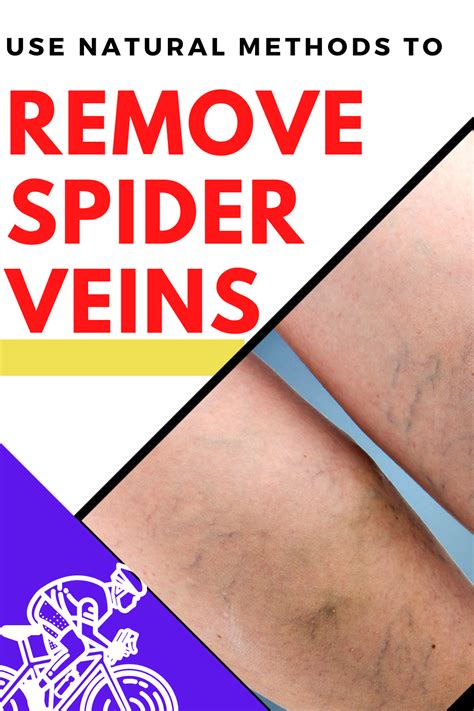 Spider Veins Removal Natural Remedies In 2021 Spider Veins Remove Spider Veins Vein Removal
