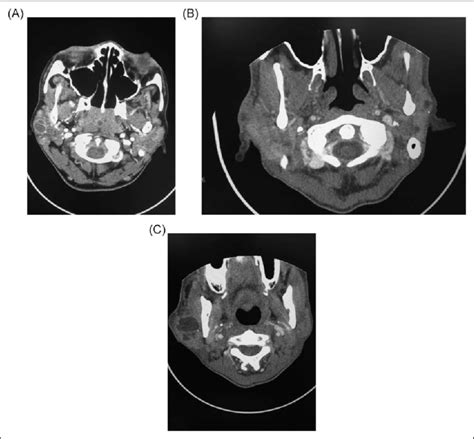 Contrast Enhanced Computed Tomography Ct Images Of The Neck Show A