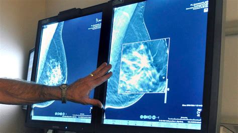 Mammogram Guidelines Now Consider Womens Personal Values Not Just Age