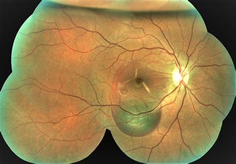 Pneumatic Displacement Of Submacular Haemorrhage Retina Image Bank